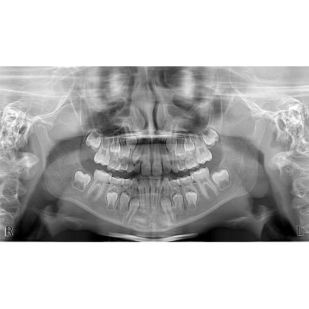 Aparat radiologie ortopantomograf OPG Stellaris 2D cu brat cefalometric