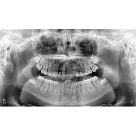 Aparat radiologie ortopantomograf OPG Stellaris 2D cu brat cefalometric