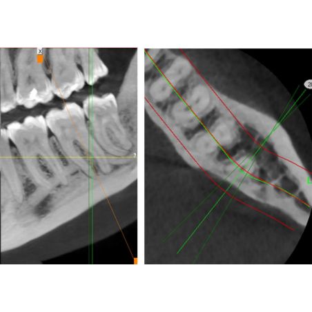 Aparat CBCT Stellaris 3D cu brat cefalometric